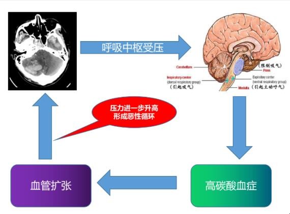 chiari畸形